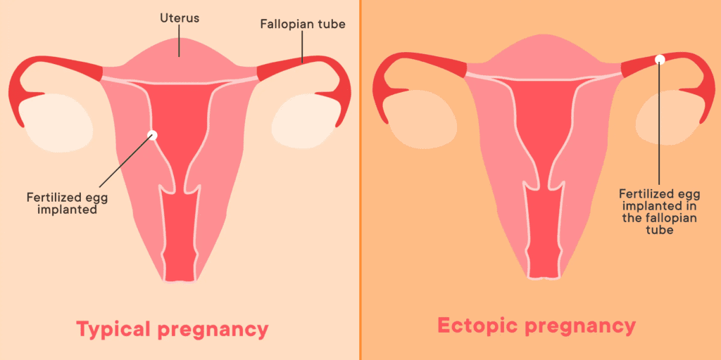 What Is Ectopic Pregnancy? Typical pregnancy versus ectopic pregnancy