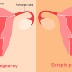ectopic pregnancy