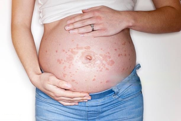 What to Do to Get Relief from Pregnancy Rash? A pregnant woman with rashes on her abdomen, also called pregnancy rash or PUPPPs