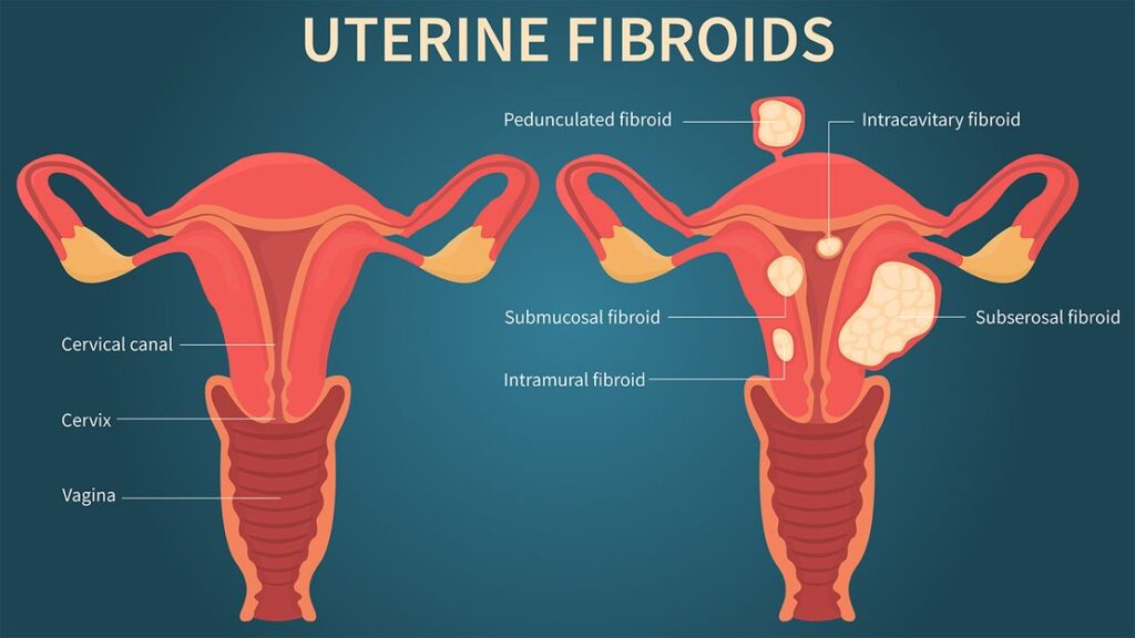 Pelvic Pain During Pregnancy - Normal uterus versus fibroid uterus