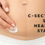 C Section Scar Healing Stages