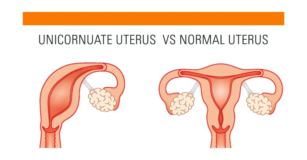 unicornuate Uterus  vs normal uterus - Unicornuate Uterus Pregnancy