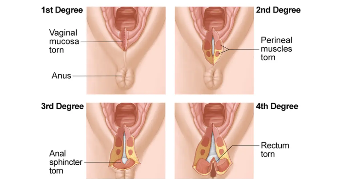 4 types of perineal tears