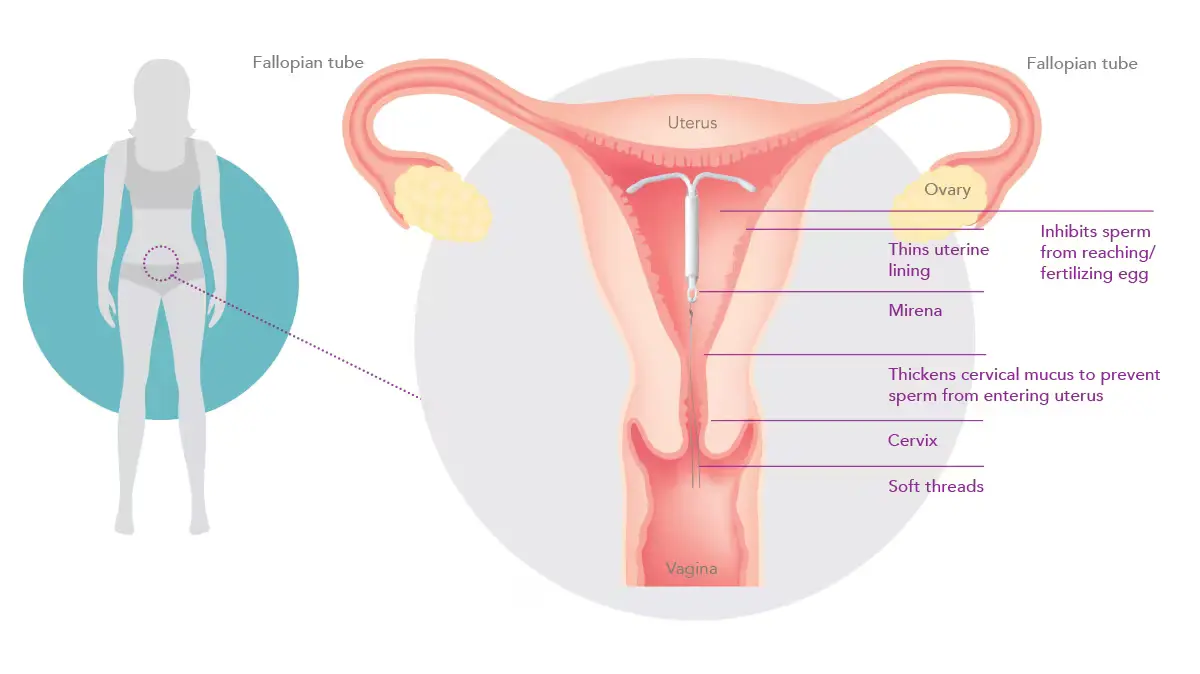 mirena iud insertion diagram