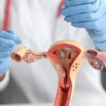 Getting Your Tubes Tied