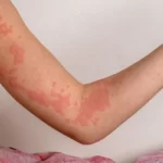 Pregnancy Induced Hives